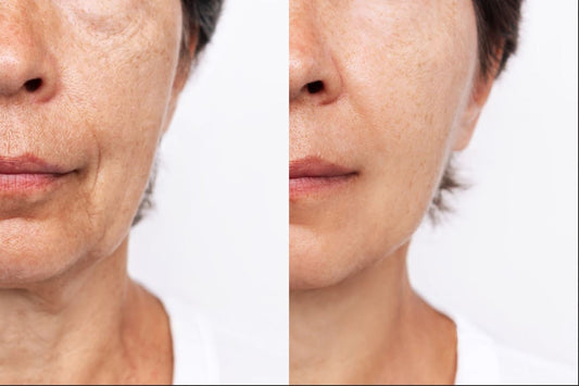 Before and After - microneedling