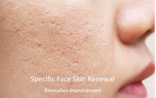 pbserum Specific Acne Scars
