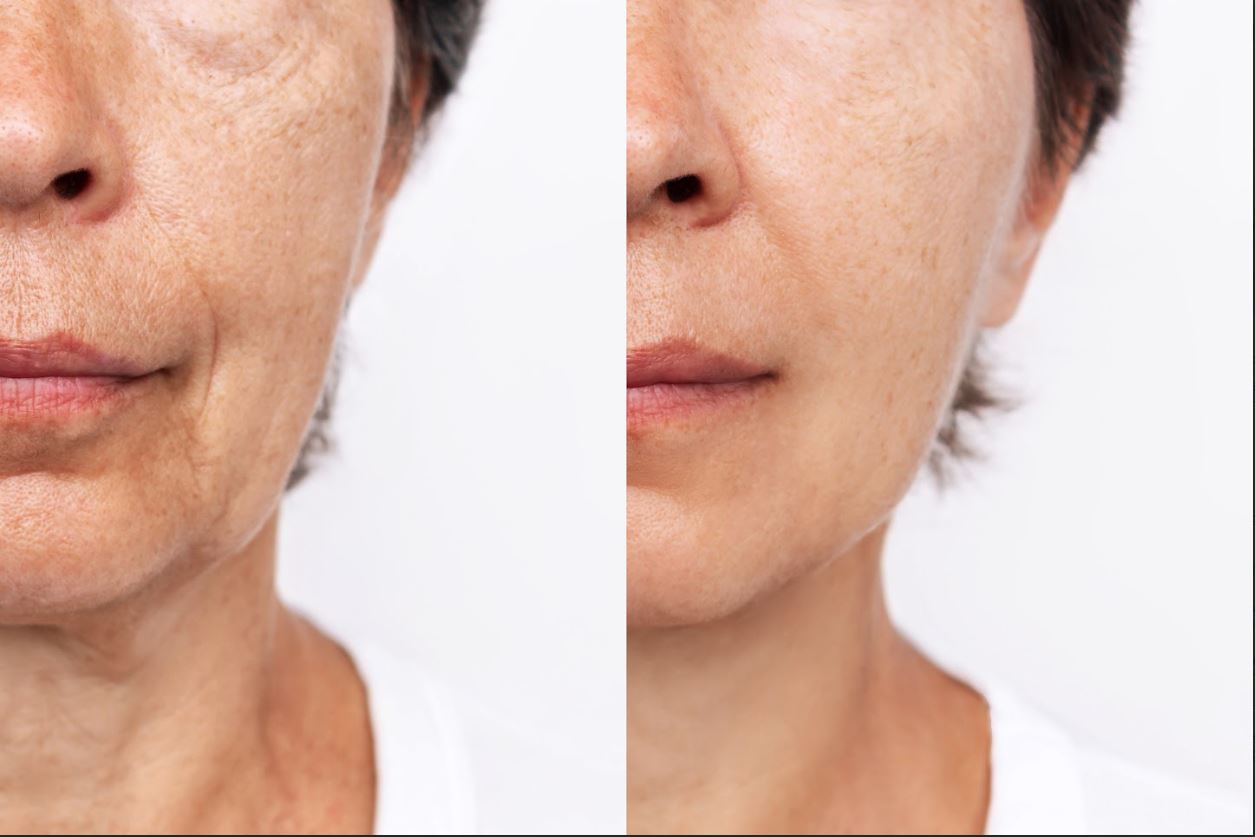 Before and After - microneedling 